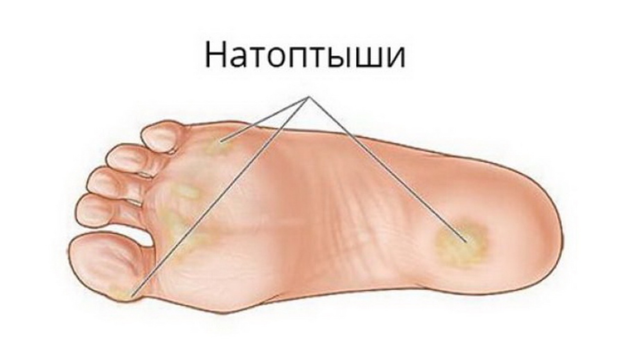 От натоптышей помогут чеснок и яблоки