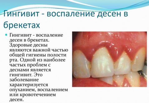 Гингвит, пародонтит, пародонтоз