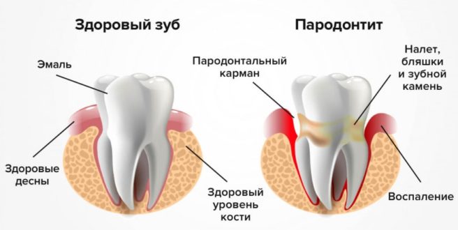 Гингвит, пародонтит, пародонтоз
