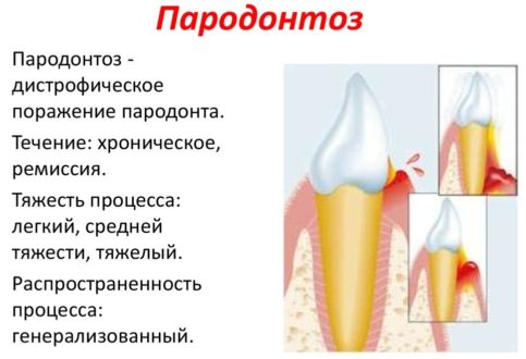 Гингвит, пародонтит, пародонтоз