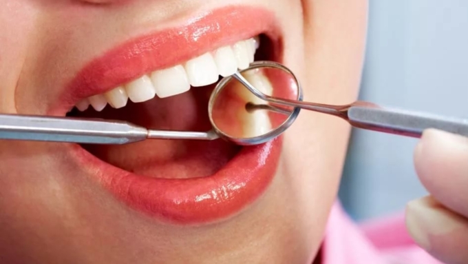 реставрация зубов