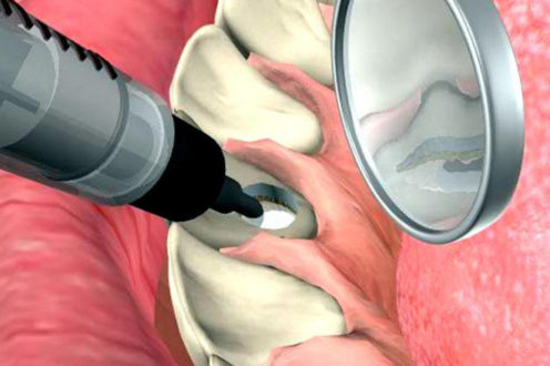 Отбеливание зубов цена
