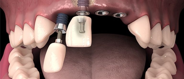 Установка зубных имплантов