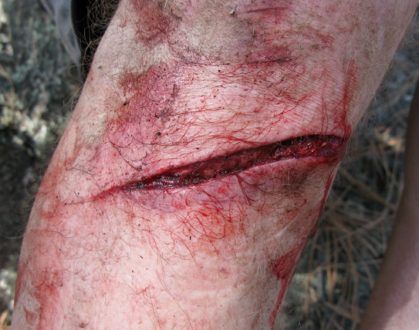 Какие бывают раны?