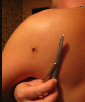 Какие бывают раны?