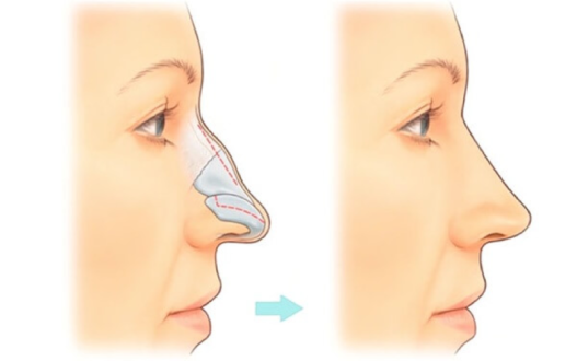 Коррекция носа
