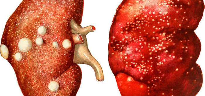 туберкулез почек