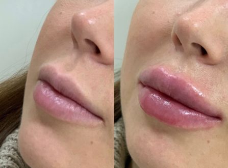 Безопасная пластика: исправляем форму губ с помощью филлеров