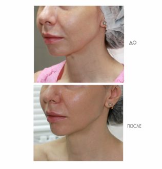 Безопасная пластика: исправляем форму губ с помощью филлеров