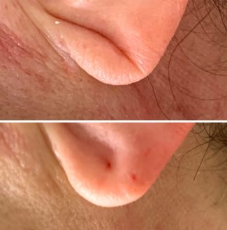 Безопасная пластика: исправляем форму губ с помощью филлеров