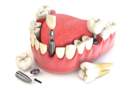 Профессиональное протезирование зубов в Минске