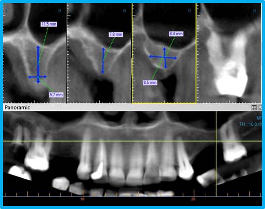 Имплантация зубов: нюансы подготовки к процедуре