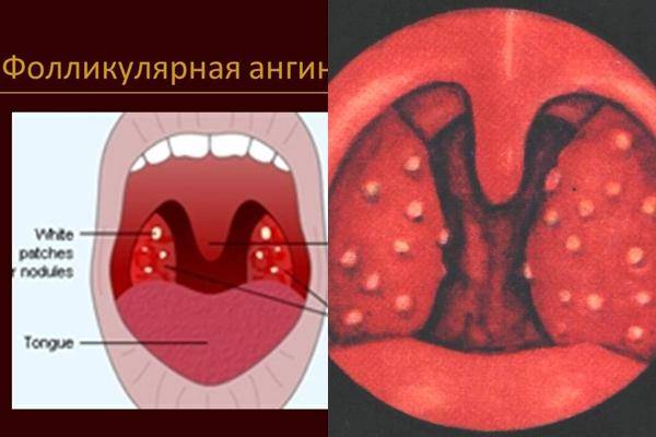 Фолликулярная ангина: лечение. Чем лечить ангину у взрослого?