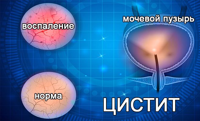 Виды урологических заболеваний