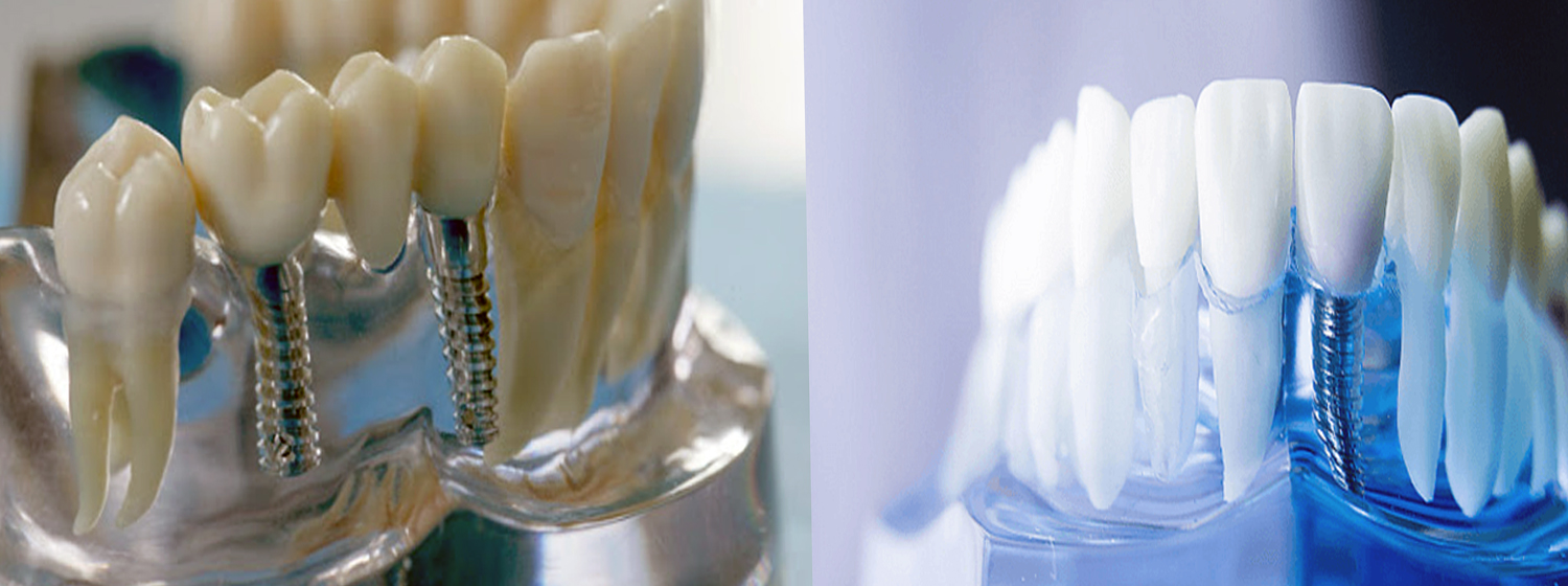 Как осуществляется протезирование зубов в Москве в клинике