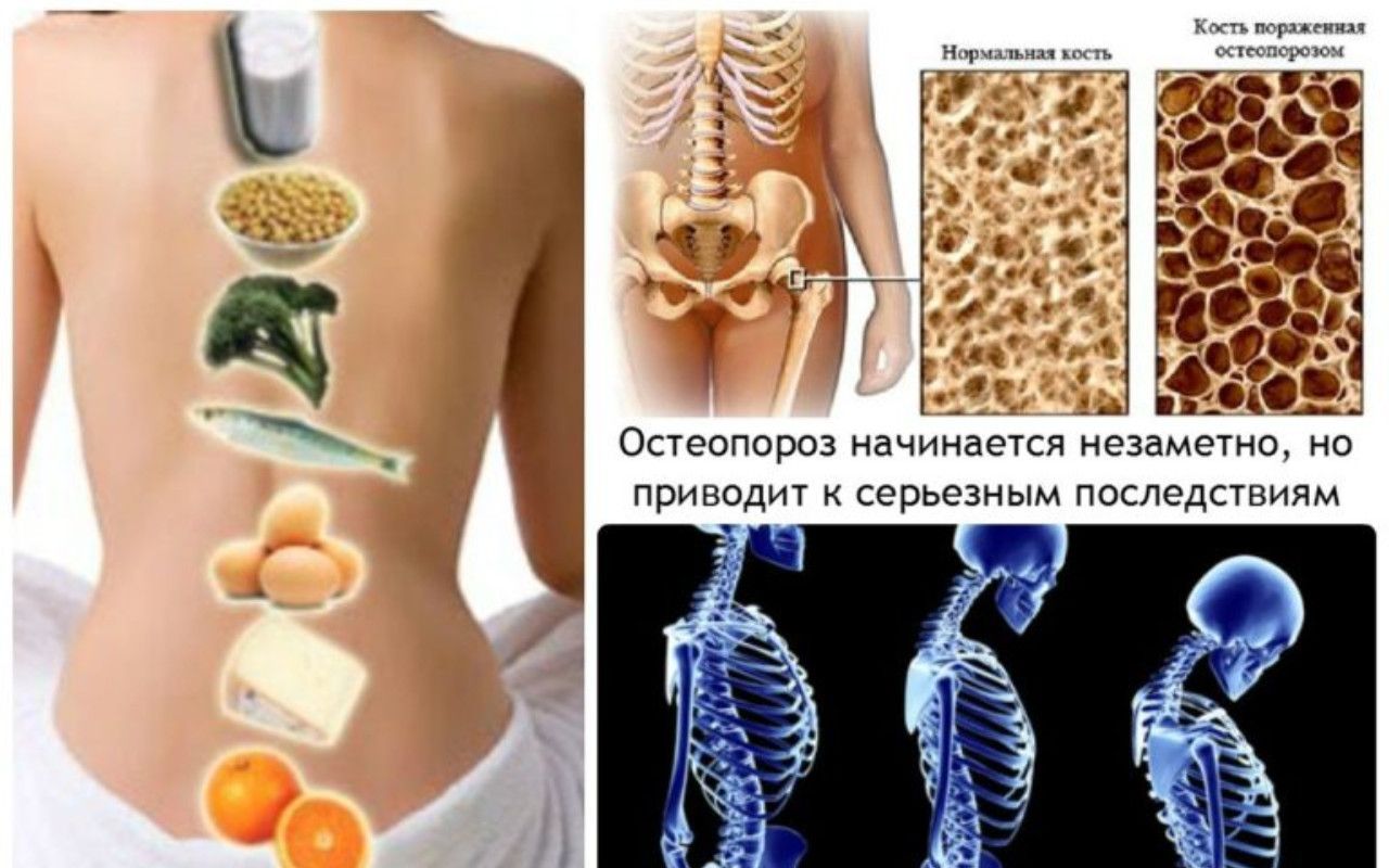 Переломы можно предотвратить? Да, если следить за потреблением кальция