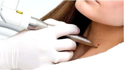 Преимущество лазерной терапии