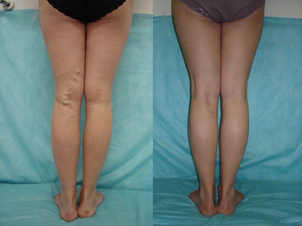 Лечение расширения вен лазером