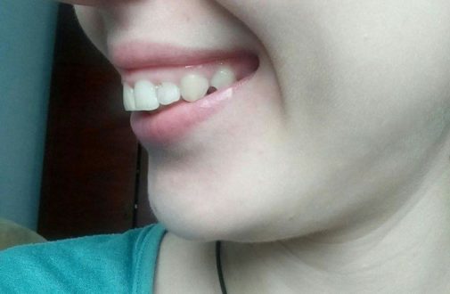 Как исправить десневую улыбку