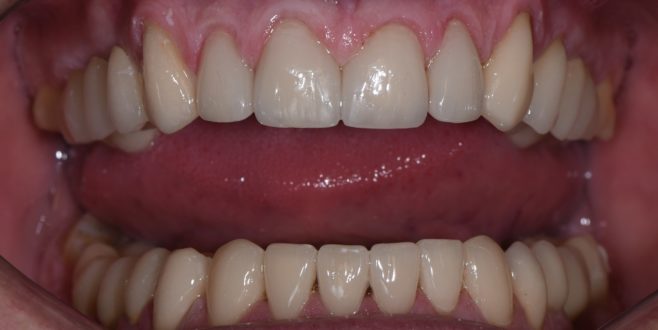 Протезирование зубов: как проходит процедура