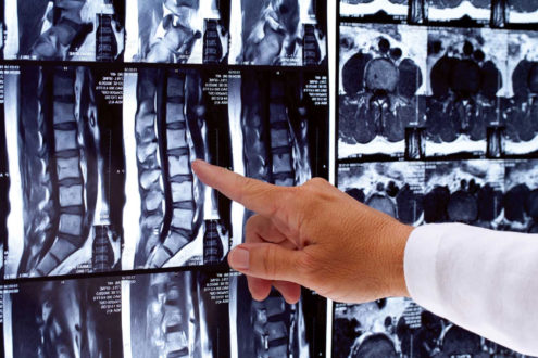 Что такое дорзальная грыжа и как ее лечить