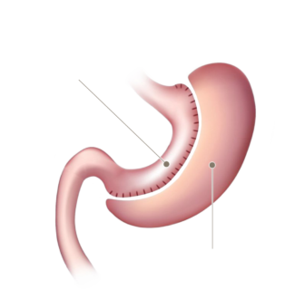 Робот-ассистированная резекция и полное удаление желудка