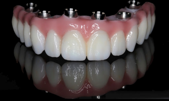 Особенности имплантации зубов