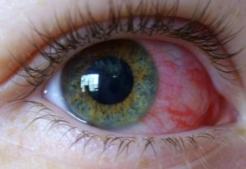 Лечение иридоциклита