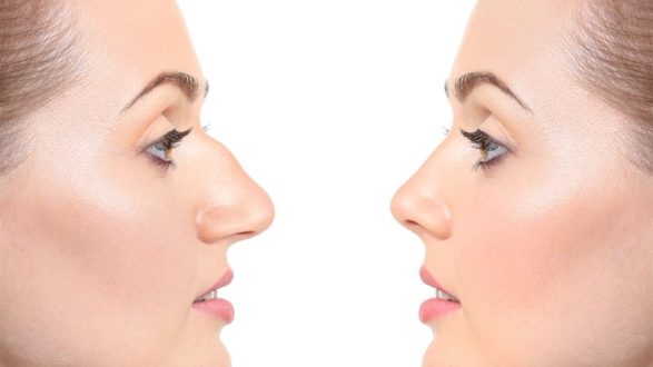 Открытая ринопластика что это и кому подходит