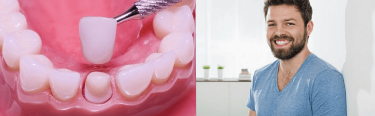 Основные виды зубных коронок