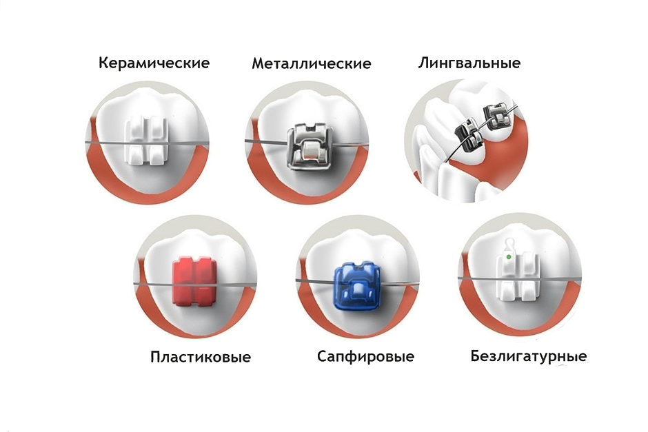 Виды брекет-систем