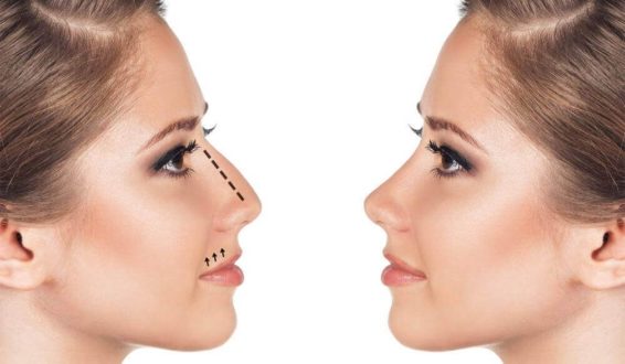 Особенности ринопластики в Турции