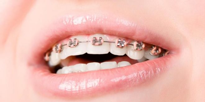 Брекеты для ваших зубов