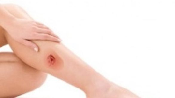 Трофические язвы на ногах