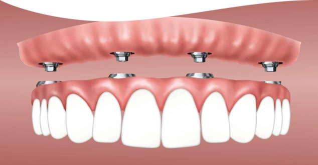 5 шагов к успешной имплантации зубов