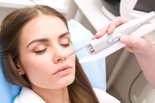 Удаление купероза лазером - особенности