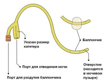 Промывание катетера и мочевого пузыря