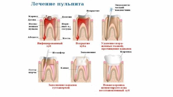 Лечение пульпита - особенности