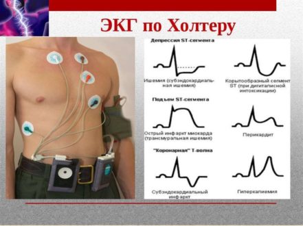 Виды ЭКГ-обследования и особенности процедуры