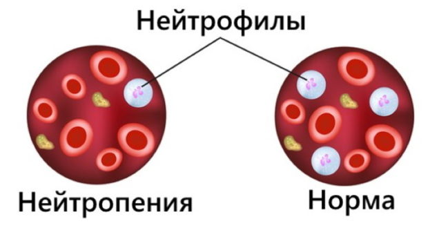 Что такое нейтропения, диагностика и лечение