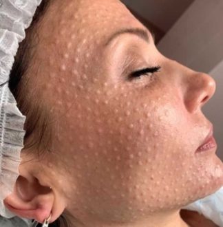 Біоревіталізація, що це таке та переваги процедури