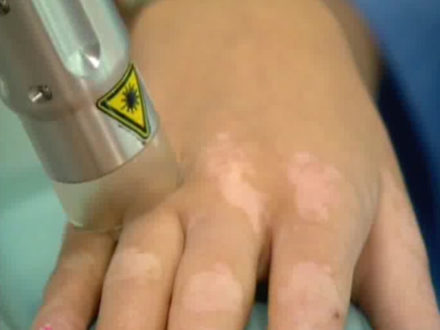 Важность лечения витилиго