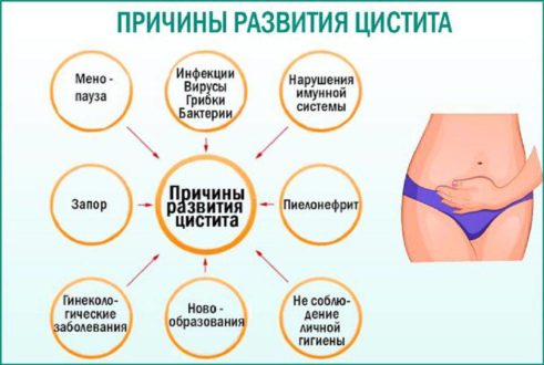 Лікування циститу - особливості та переваги
