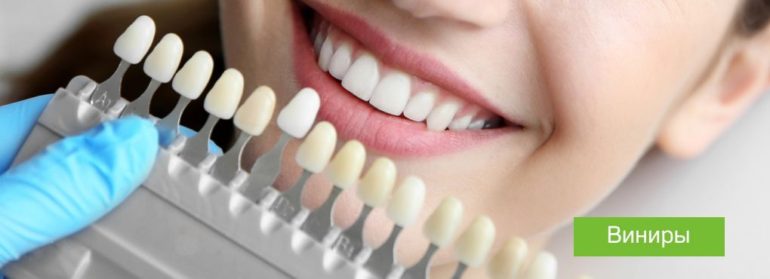 Вініри під ключ- особливості та переваги