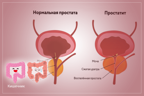 Простатит: как вылечить неприятное заболевание с помощью свечей