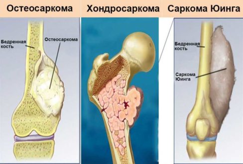 Факторы развития опухоли костей