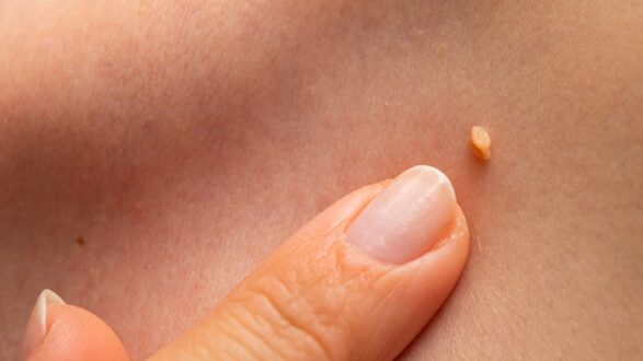 Що таке папіломи і чому вони з’являються