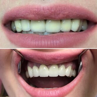 Восстановление передних зубов: эстетика и функциональность