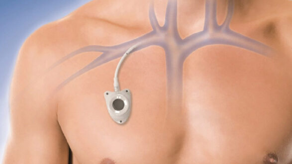 Установка порт-системы при раке молочной железы