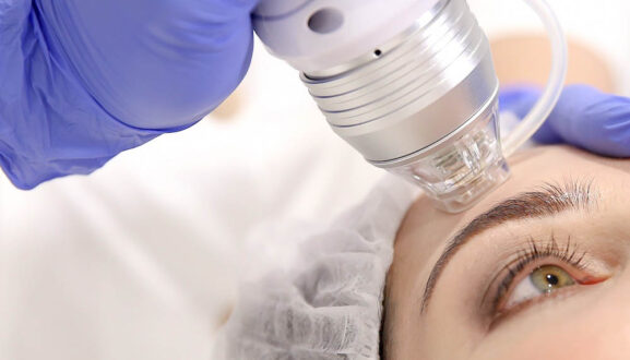 Игольчатый RF-лифтинг Vivace - особенности, преимущества